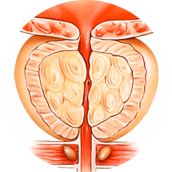 Folgen einer unbehandelten Prostatitis